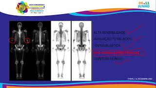 Cintilografia óssea  características do método nuclearmedicine bone [upl. by Borer]