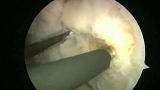 Arthroscopic Latarjet  BristowLatarjet Instability Shoulder System [upl. by Nahn]