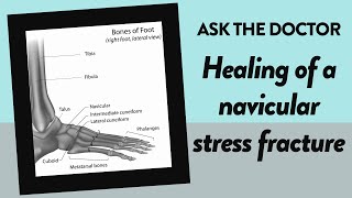 Ask the Doctor Healing of a navicular stress fracture [upl. by Onitnelav]