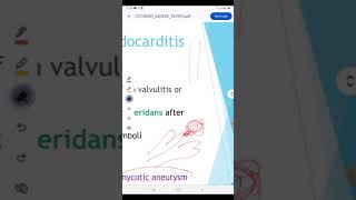 Infective endocarditis [upl. by Anib508]