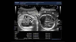 Ultrasound Video showing Hydrops fetalis Soft tissue edeme and Fetal pleural effusion [upl. by Julee]