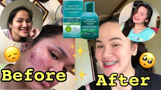 MAXIPEEL EXFOLIANT SOLUTION 2 REVIEW  FADED MY ACNE SCARS AND PIMPLES [upl. by Gillan81]