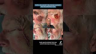 MALIGNANT MELANOMA SURGERY AND RECONSTRUCTION [upl. by Monagan]