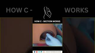 Cesarean Section Explained Why Doctors Choose CSections for a Safer Birth 👶✂️ Cesarean Birth [upl. by Noedig727]