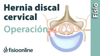 Hernia discal cervical Operación quirúrgica o cirugía [upl. by Codie]