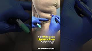 HighDefinition Liposuction  Available at Manikonda amp Nallagandla  Personiks [upl. by Eicarg]