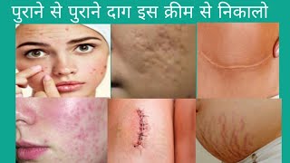 Contractubex gel ke use reviews in Hindi  purana se purana Daag nikalne ki best cream [upl. by Stace628]