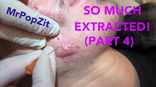 So much extracted Severe acne before and after Session 2 Comedones for days [upl. by Akitan]