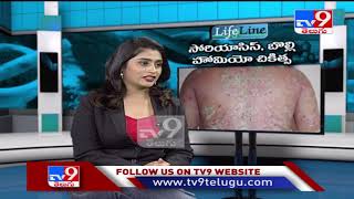 Psoriasis amp Vitiligo Diseases  Homeopathic treatment  Lifeline  TV9 [upl. by Leugimesoj]