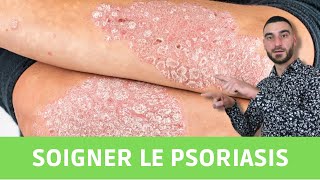 Comment soigner le psoriasis naturellement [upl. by Lawtun]