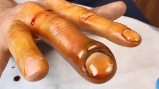 Paronychia PusFilled Infected Nail Treatment Procedure [upl. by Kcirddehs469]