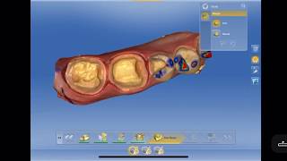 CEREC Crowns 3031 Inlay 29 [upl. by Tidwell]