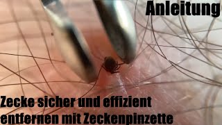 Zecke sicher und effizient entfernen für Mensch und Tier mit Zeckenpinzette in Löffelform Anleitung [upl. by Tanny393]