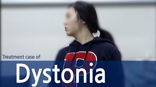 dystonia  Cervical Dystonia  Spasmodic torticollis  사경증 치료사례  근긴장이상증 [upl. by Sells]