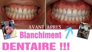 Blanchiment dentaire  AVANTAPRES Revue 25 [upl. by Aiker]