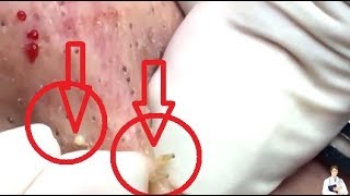 FINDING BLACKHEADS PART 2 [upl. by Maretz79]