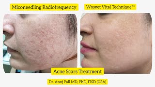 Acne scars treatment with Microneedling Radiofrequency  Subcision  Wosyet Vital Technique™ [upl. by Attenreb698]