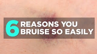 6 Reasons You Bruise So Easily  Health [upl. by Ihsir581]