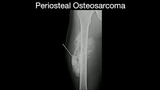 Periosteal Osteosarcoma [upl. by Bicknell]