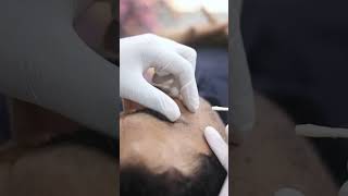 Skinaa Clinic Xanthelasma Treatment Video viral shorts skinaaclinic [upl. by Teerprah298]