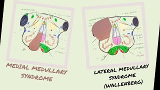 Medial amp Lateral Medullary Syndromes  Wallenberg Syndrome  Vascular lesions of Medulla [upl. by Sair343]