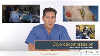 Cryo neuroma decompression update 2023 [upl. by Moishe397]