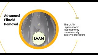 LAAM CIGC’s FastRecovery Laparoscopic Myomectomy [upl. by Enirod564]