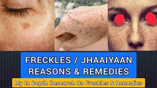 Freckles  ज्ञाइयां  What Why Types Home remedies Other Treatments  With English Subtitles [upl. by Ru307]