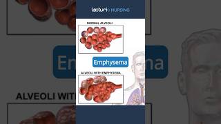 Exploring Emphysema 🔍 Emphysema RespiratoryCare nclexrn [upl. by Epotimet]