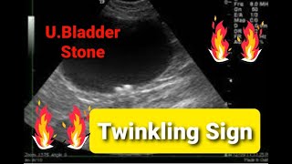 Urinary Bladder stone l Twinkling Sign l💥💥💥 [upl. by Kingston876]