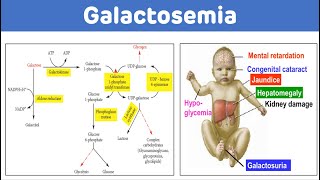 Galactosemia And Galactose Metabolism  Galactosemia Biochemistry [upl. by Duston255]