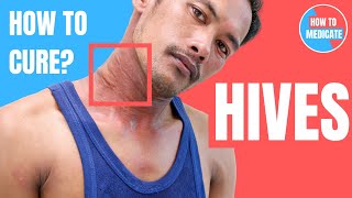 How to treat Hives Urticaria  Doctor Explains [upl. by Alfred315]