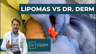 Lipomas vs Dr Derm  Dr Derm [upl. by Ecirtnom]