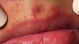 Most Painful Blackhead Removal on Lips [upl. by Ytsanyd]