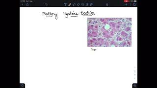 Mallory hyaline bodies seen in [upl. by Jennee]