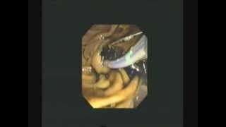 ERCP  Sphincterotomy biopsies amp SEMS for Pancreatic cancer  STEFANOS DOKAS  The ERCP Channel [upl. by Bordie412]