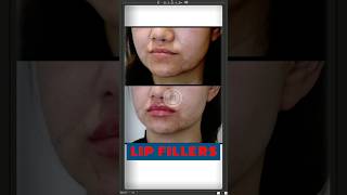 Get READY for Plump Lips with Lip Fillers  Sarayu Clinics filler [upl. by Alethea]