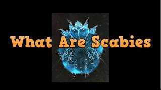 ★★★ What Are Scabies How To Treat Scabies In Your Scalp Natural Scabies Treatment Scabies Curable [upl. by Moir562]