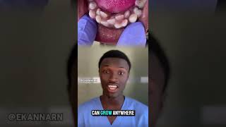 Hyperdontia is a condition where a person has extra teeth known as supernumerary teeth hyperdontia [upl. by Juana]