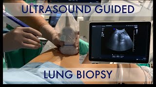 USguided lung biopsy [upl. by Terchie161]