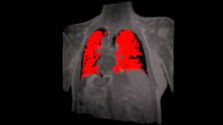 Dynamic contrast enhanced MRI of the lungs [upl. by Zoubek]