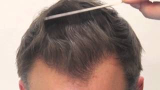 Dr Rahal Results  5672 FUT Grafts  Rahal Hair Transplant [upl. by Froh]