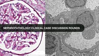 2019 06 27 Nephropathology Clinical Case Discussion Rounds [upl. by Pembroke485]