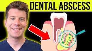 Doctor explains DENTAL ABSCESS tooth abscess  Causes symptoms amp treatment [upl. by Centeno]