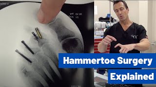 Hammertoe Correction Surgery Explained by Dr Moore  Using the Phalinx Hammertoe Fixation System [upl. by Arreit]