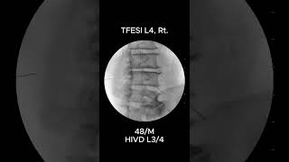 How to Accurately Perform L4 Transforaminal Epidural Steroid Injection TFESI 3 [upl. by Egbert972]