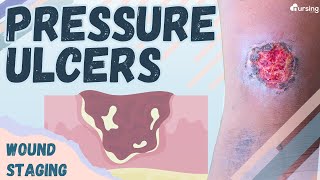 Pressure Ulcers Wound Staging Nursing [upl. by Annehcu]