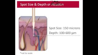 New SandstoneEllman Matrix LS40 Fractional CO2 Laser with 1 Year Warranty [upl. by Oigimer]