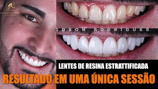 LENTES DE RESINA EM UMA SESSÃO [upl. by Gschu486]