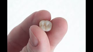 1st Lower Molar  Composite [upl. by Gherardi210]